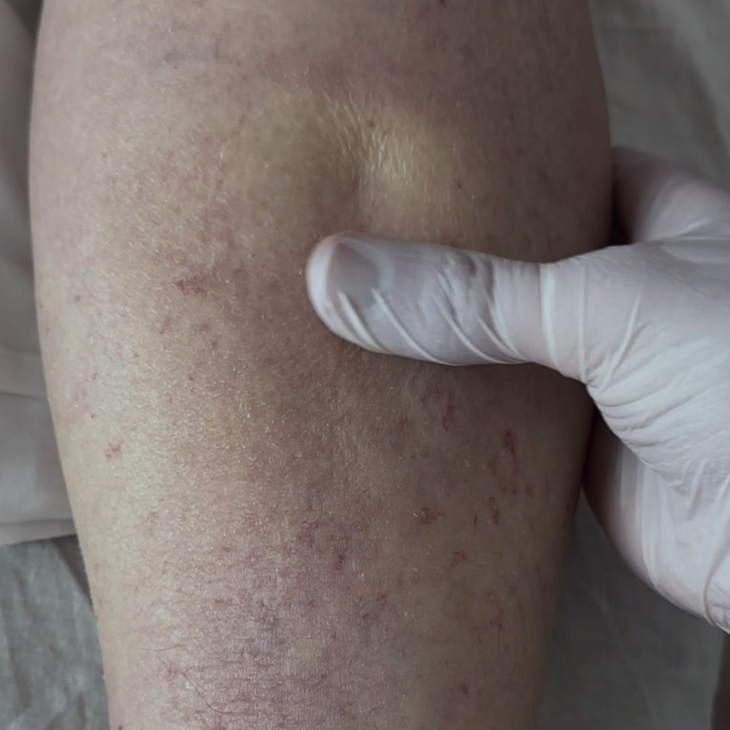 SpecializedManagementof Lymphedema